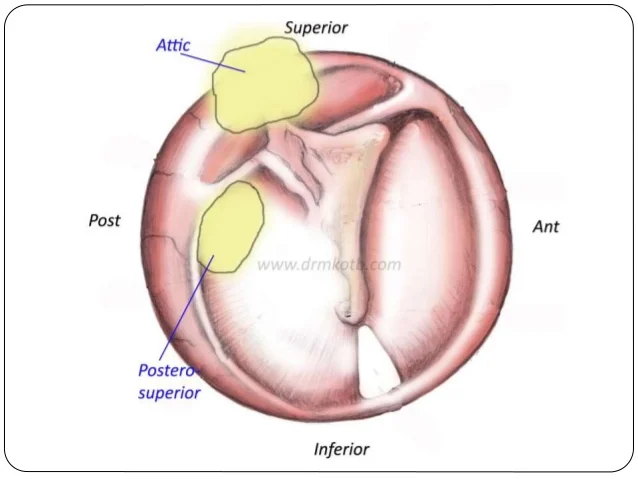 chronic tubotympanic suppurative otitis media