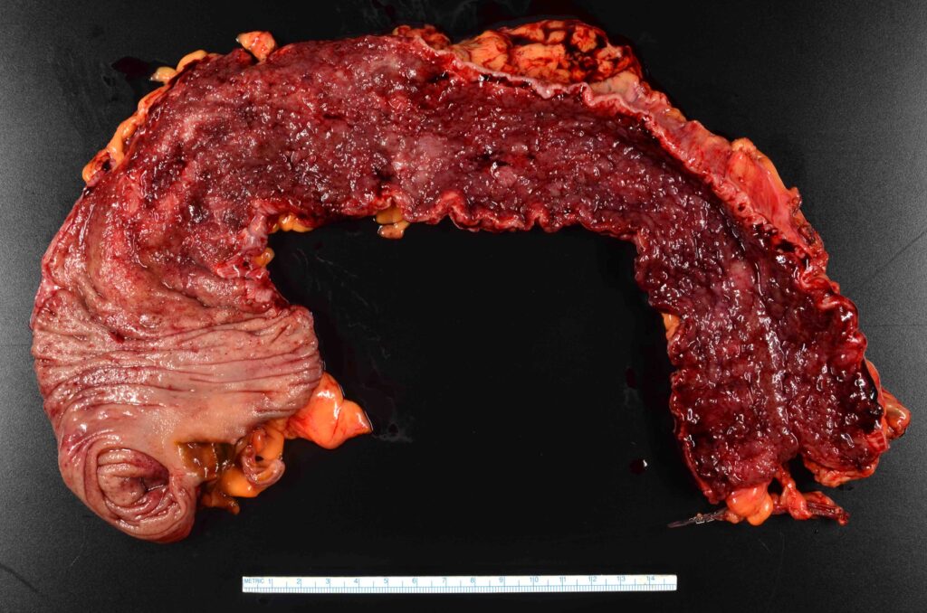 chronic ulcerative rectosigmoiditis