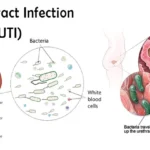 citrobacter complicated uti