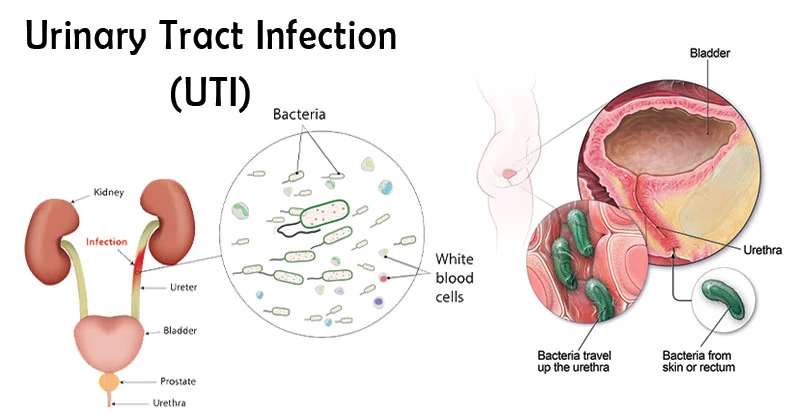 citrobacter complicated uti