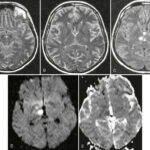 citrobacter meningitis