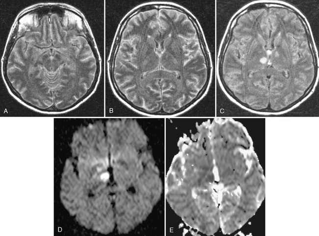 citrobacter meningitis