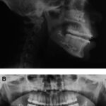 citrobacter osteomyelitis