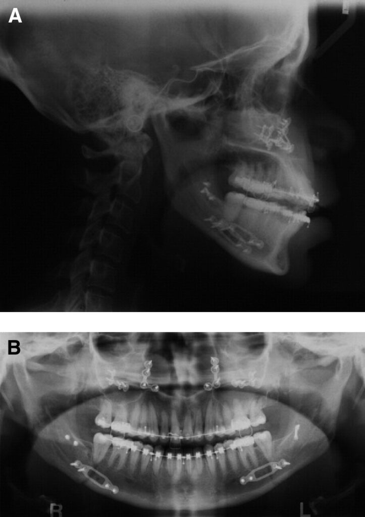 citrobacter osteomyelitis