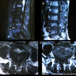 citrobacter peritonitis