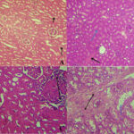 citrobacter pneumonia