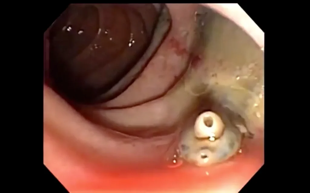 clonorchiasis due to c. sinensis