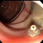 clonorchiasis due to c. sinensis