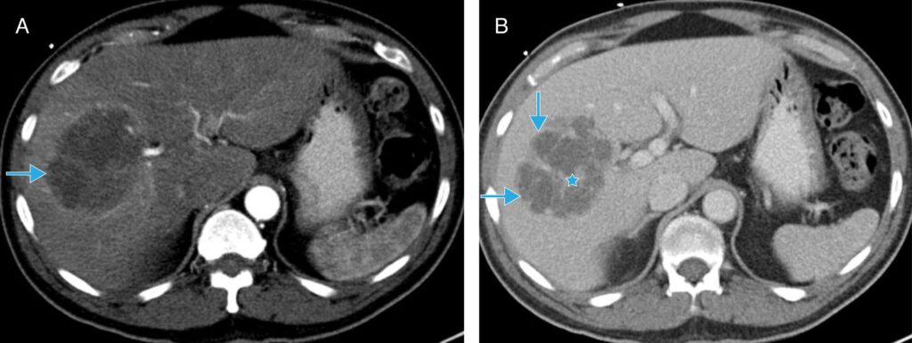 clostridium liver abscess