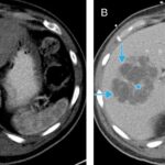 clostridium liver abscess