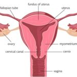 clostridium pelvic cellulitis