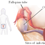 clostridium tubo-ovarian abscess