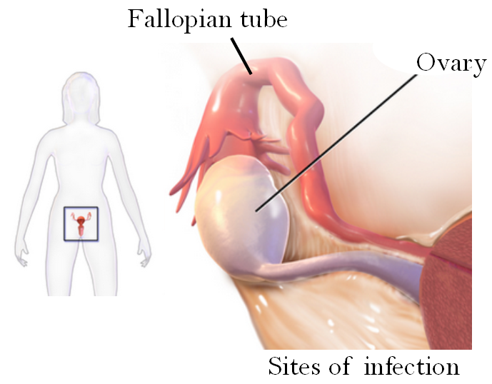 clostridium tubo-ovarian abscess