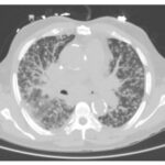 chronic pulmonary histoplasmosis