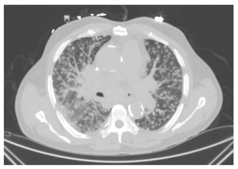 chronic pulmonary histoplasmosis