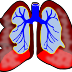 bacteroides pneumonia