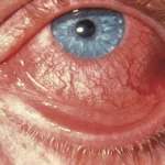 bacterial eye infection