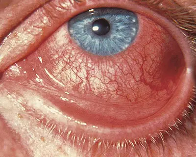 bacterial eye infection