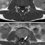 cmv-related polyradiculopathy in aids patient