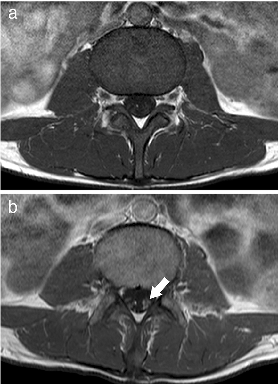 cmv-related polyradiculopathy in aids patient