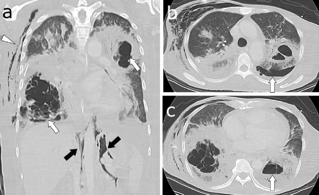 enterobacter pneumonia