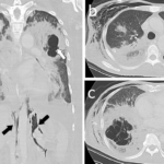 enterobacter pneumonia