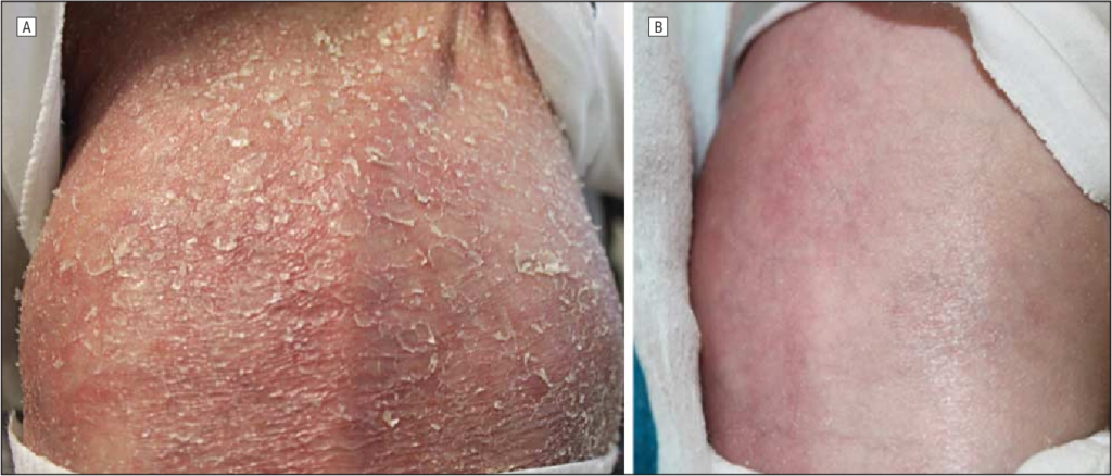 deficiency of interleukin-1 receptor antagonist