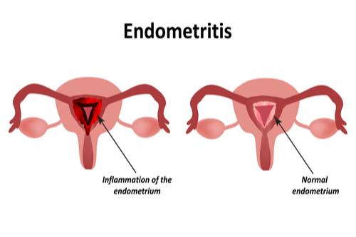 Acute Gonococcal Endometritis