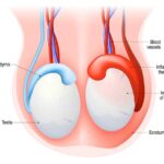 Acute Gonococcal Epididymo Orchitis