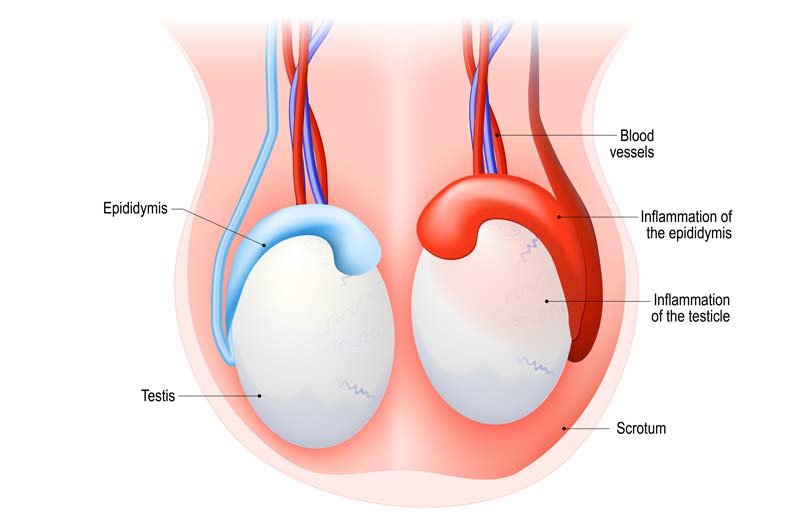 Acute Gonococcal Epididymo Orchitis