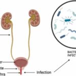 Acute Gonococcal Urethritis