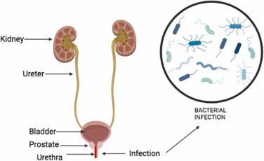 Acute Gonococcal Urethritis