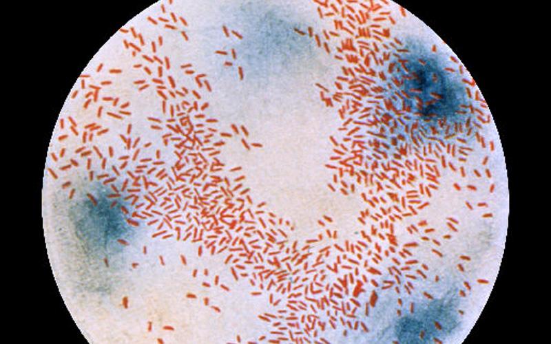 Acute Haemophilus Parahaemolyticus Bacterial Sinusitis