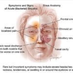 Acute Haemophilus parainfluenzae Bacterial Sinusitis