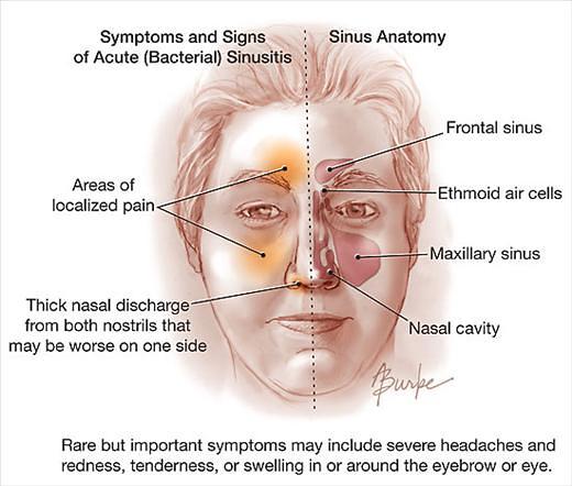 Acute Haemophilus parainfluenzae Bacterial Sinusitis