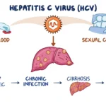 Acute Hepatitis C