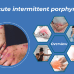 Acute Intermittent Porphyria