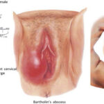 Acute Lower Genitourinary Gonorrhea