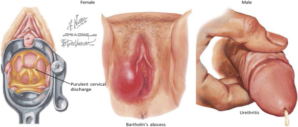 Acute Lower Genitourinary Gonorrhea