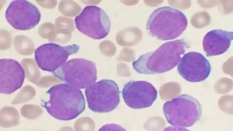 Acute Lymphoid Leukemia