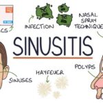 Acute Maxillary Haemophilus Influenzae Sinusitis