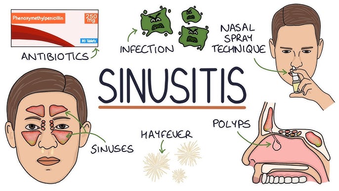 Acute Maxillary Haemophilus Influenzae Sinusitis