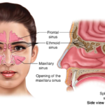 Acute Maxillary Moraxella Catarrhalis SinusitisAcute Maxillary Moraxella Catarrhalis Sinusitis