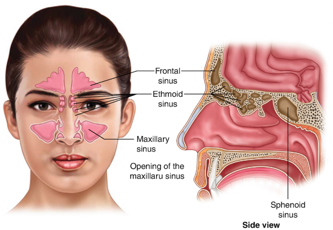 Acute Maxillary Moraxella Catarrhalis SinusitisAcute Maxillary Moraxella Catarrhalis Sinusitis