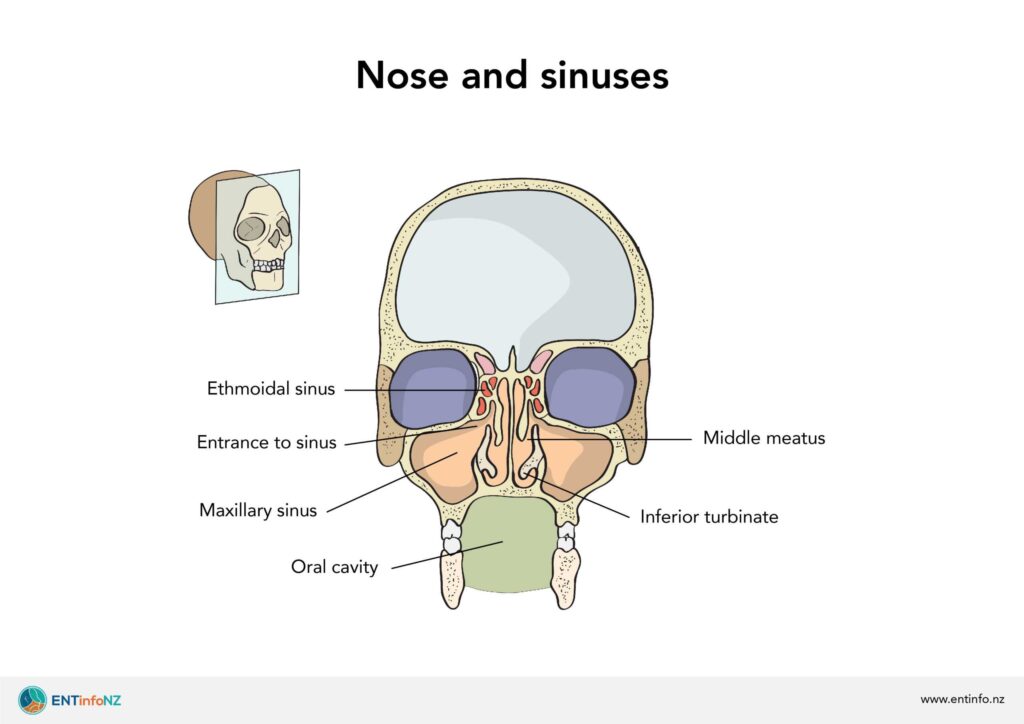 Acute Maxillary Streptococcus pneumoniae Sinusitis