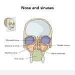 Acute Maxillary Streptococcus pneumoniae Sinusitis