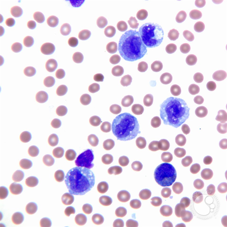 Acute Monocytic Leukemia