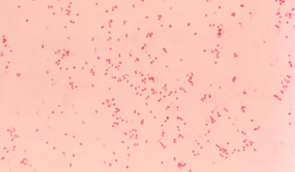 Acute Moraxella Catarrhalis Bacterial Sinusitis