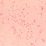 Acute Moraxella Catarrhalis Bacterial Sinusitis