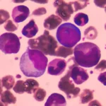 Acute Myeloid Leukemia with FLT3 Mutation